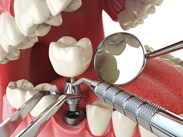 Best Emergency Dentist for Lost Fillings or Crowns in Exton, PA